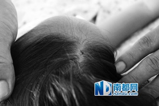 女童頭上被扎的針孔（圓圈處）。賈先生說，被扎不到三秒鐘，女兒就昏了。