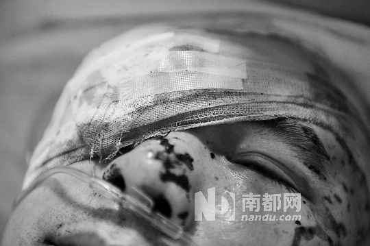 李建新頭部還有被潑硫酸的痕跡，醫(yī)生說被砍傷的右眼已經(jīng)失明。 南都記者 田飛 攝