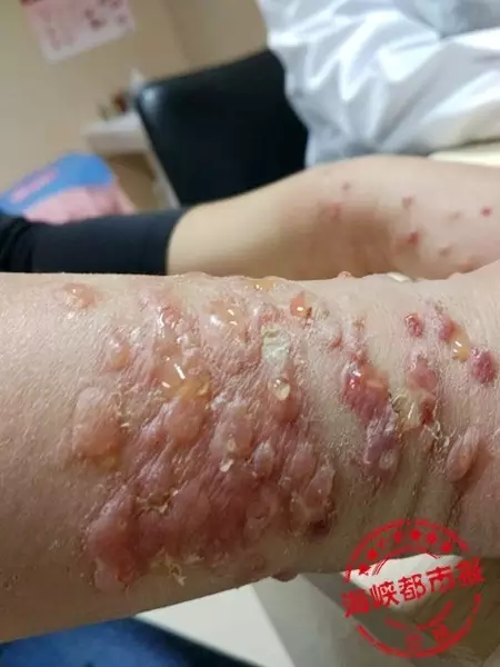 男子釣魚感覺(jué)手腕有小蟲(chóng) 拍死后瞬間雙手起皰潰爛