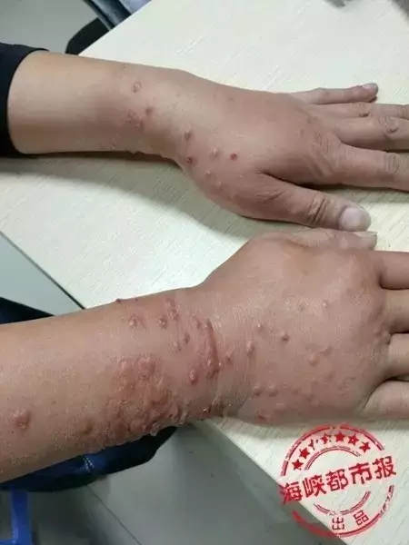 男子釣魚感覺(jué)手腕有小蟲(chóng) 拍死后瞬間雙手起皰潰爛