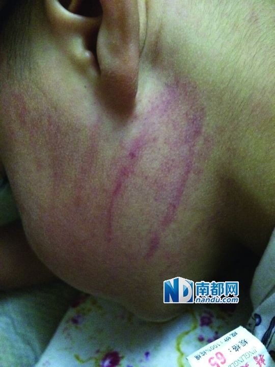 小逸臉上淤痕清晰可見。