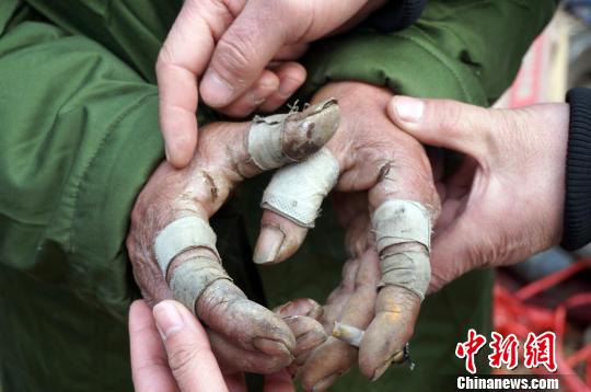 圖為由于常年拾荒，老人雙手布滿傷口。周小云 攝